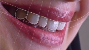 درمان کوتاهی دندان جلو با لمینت