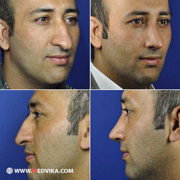 عمل جراحی بینی مردان در مشهد