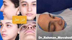 قبل و بعد از جراحی بینی گوشتی مشهد
