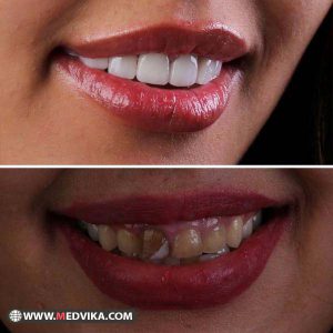 قبل و بعد ونیر کامپوزیت دندان در مشهد - کلینیک کوروش