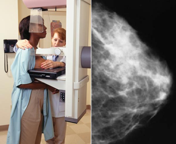 ماموگرافی قبل از عمل پروتز سینه