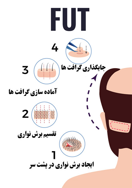 عکس مراحل کاشت مو در مشهد به روش fut