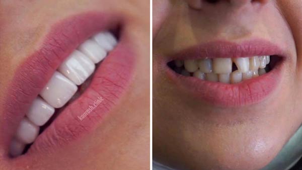 علاج تكسّر الاسنان بلومينير الاسنان