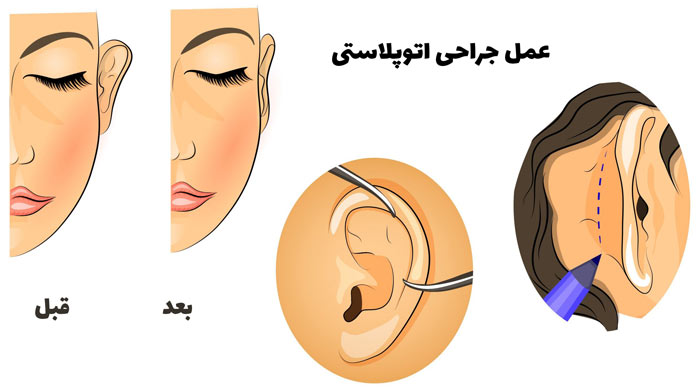 عمل جراحی زیبایی گوش در مشهد - اتوپلاستی مشهد
