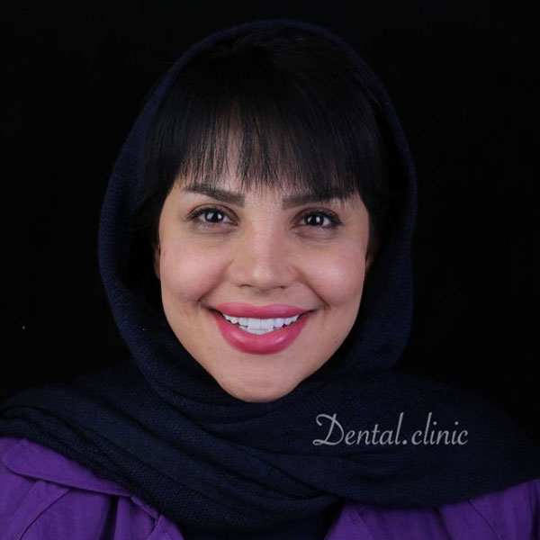 ابتسامة هوليود في ايران - افضل مركز تجميل الاسنان في ايران