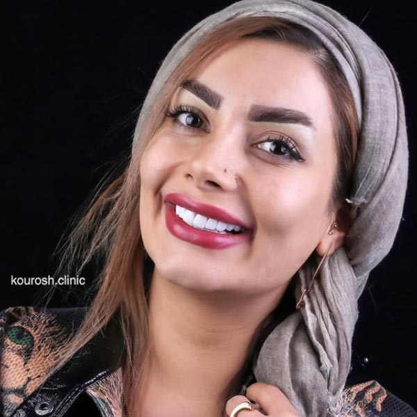 كمبوزيت الاسنان - ابتسامة هوليود في ايران