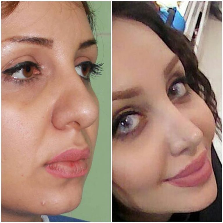 ورم بینی بعد عمل + ورم