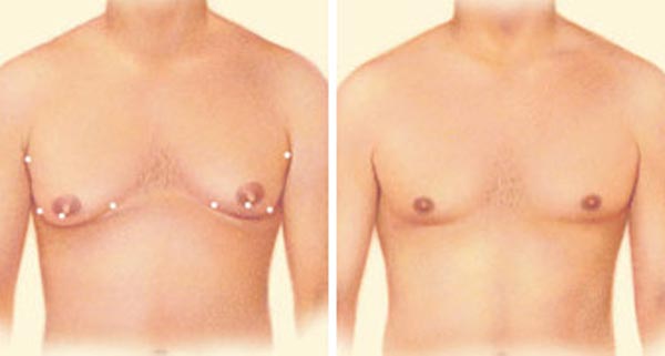 تقتية شفط الدهون الثدي في عملية جنيكوماستي