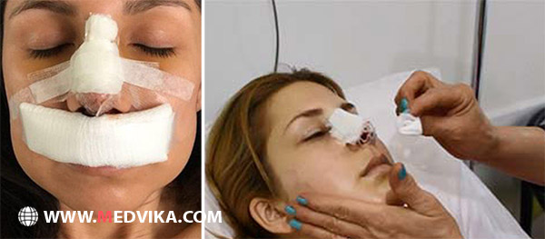 cleaning nose after rhinoplasty