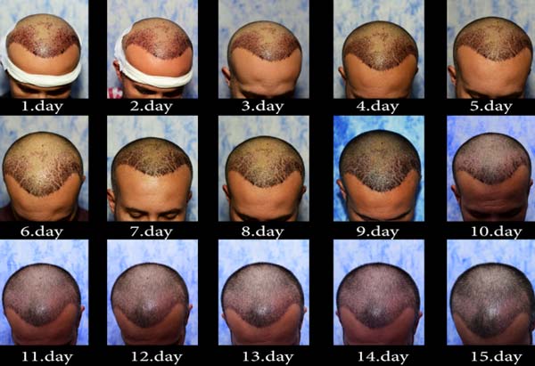 صورة مراحل نمو الشعر بعد الزراعة
