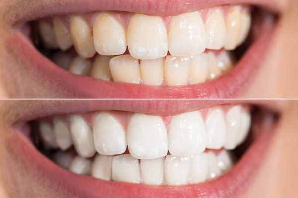 قبل و بعد بلیچینگ دندان 