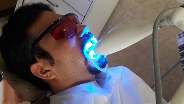 بلیچینگ دندان با اشعه در مطب - آفیس بلیچینگ