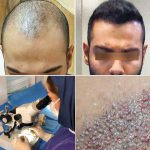 hair transplant in iran - زراعة الشعر في ايران