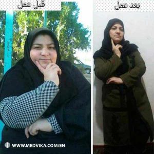 Before and After Photos of Bariatric Surgery by Dr Hamed Golmohammadzadeh