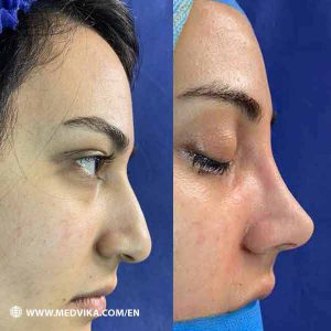 Before and After Photo of Rhinoplasty by Dr Bakhshaie