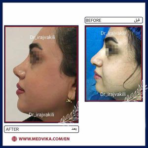 Rhinoplasty by Dr Iraj Vakili, Mashhad, Iran, Before and After Picture