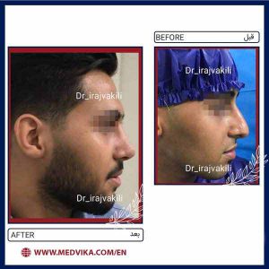 Before and After Picture of Rhinoplasty by Dr.Iraj Vakili,Mashhad,Iran