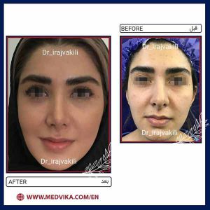 Before and After Picture of Rhinoplasty by Dr Iraj Vakili, Mashhad, Iran 4