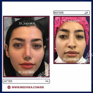 Before and After Picture of Nose Job by Dr Iraj Vakili, Mashhad, Iran