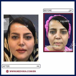 Before and After Picture of Rhinoplasty by Dr Iraj Vakili, Mashhad, Iran 6