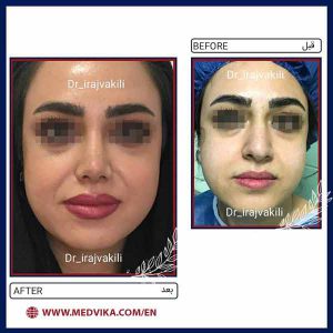 Before and After of Nose Job by Dr Iraj Vakili, Mashhad, Iran