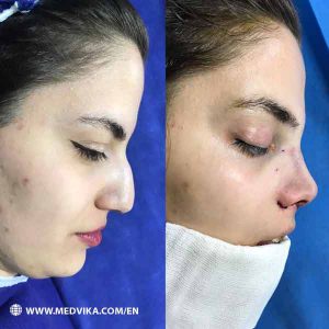 Before and After Photos of Rhinoplasty by Dr Karim Jalaeian