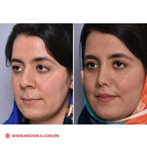 Before and After Photo of Rhinoplasty by Dr Hamed Farhdi
