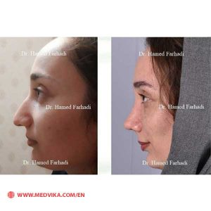Before and After Photo of Rhinoplasty by Dr. Hamed Farhadi
