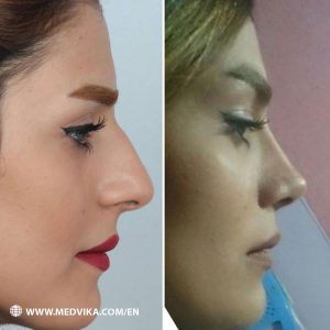 Before and After Photos of Rhinoplasty by Dr Kamran Kaviani