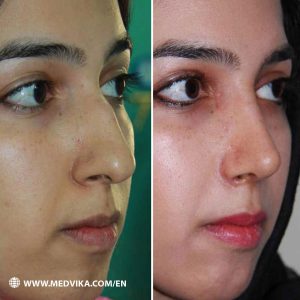 Before and After Photos of Rhinoplasty, Dr Kamran Kavianifar