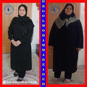 Before and After Photos of Gastric Bypass Surgery Dr Golmohammadzadeh Mashhad Iran
