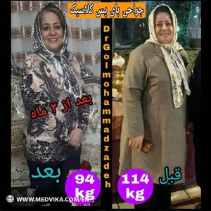 Before and After Photos of Gastric Bypass Surgery by Dr Golmohammadzadeh