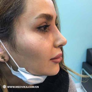 Nose Job by Dr Jalaeian