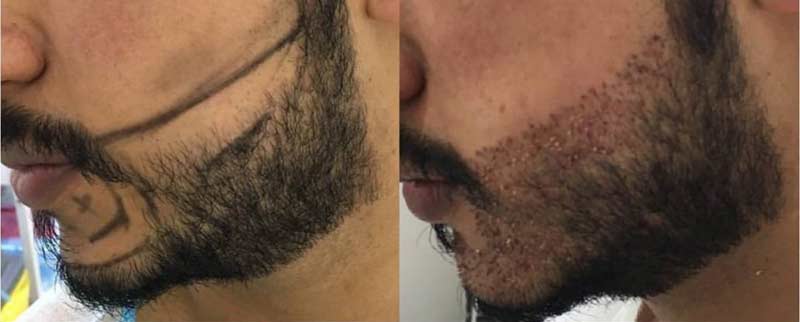 Facial Hair Transplant in Iran
