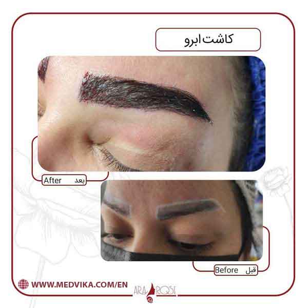 Eyebrow Transplant in Iran
