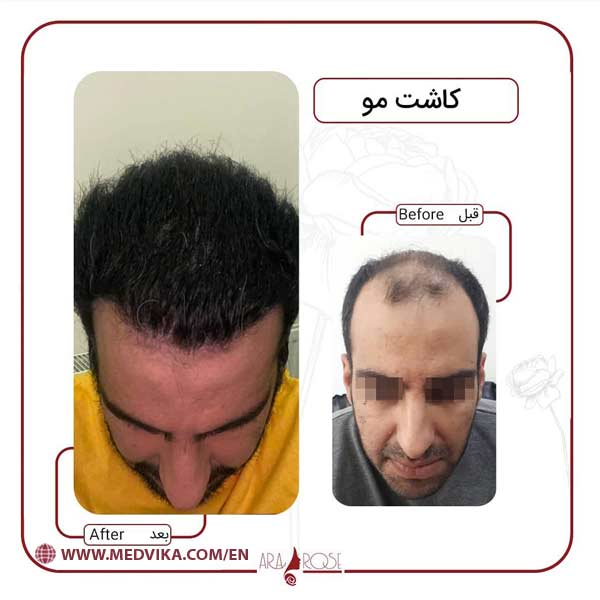 Before and After of Hair Transplant in Iran