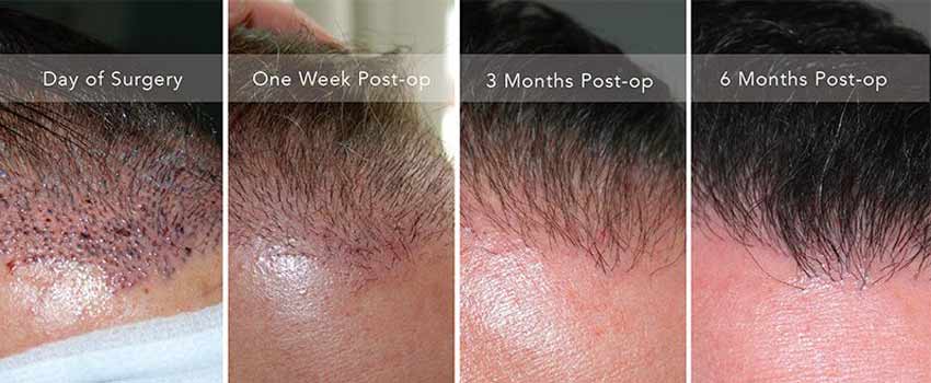 Hair Transplant in Iran: Recovery