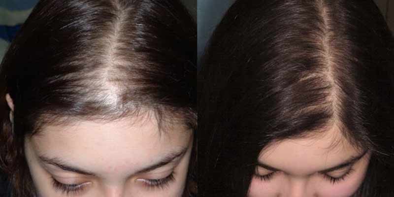 Before and After of Hair Transplant for Women