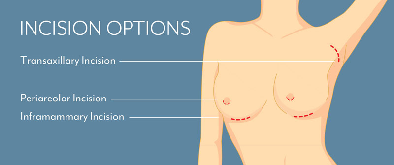 Incision Options in Breast Augmentation