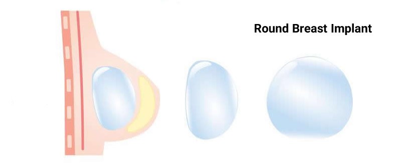Round Breast Implant