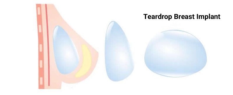 Teardrop Breast Implant