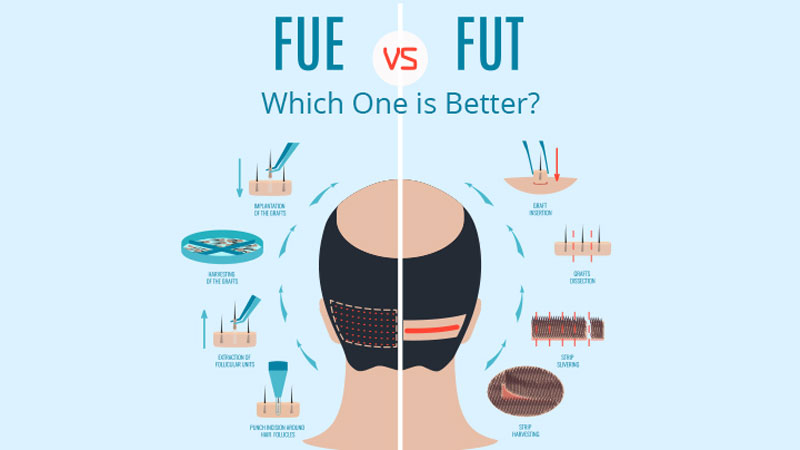 Difference Between FUE and FUT Technique