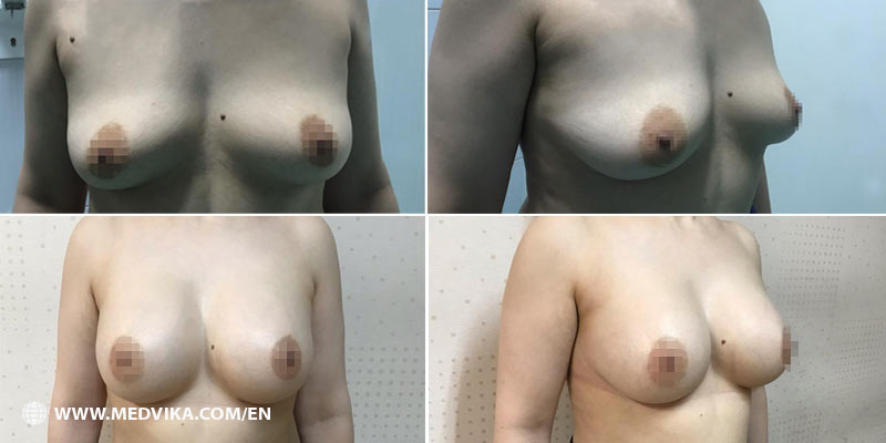 Candidates For Breast Augmentation Surgery