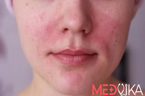 قرمزی و التهاب پوست بعد از پاکسازی صورت