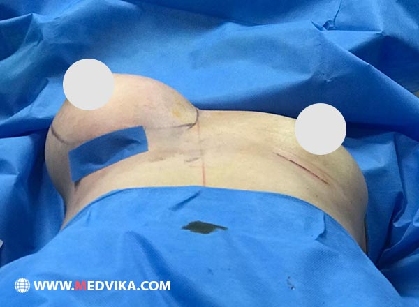 Breast prosthesis 