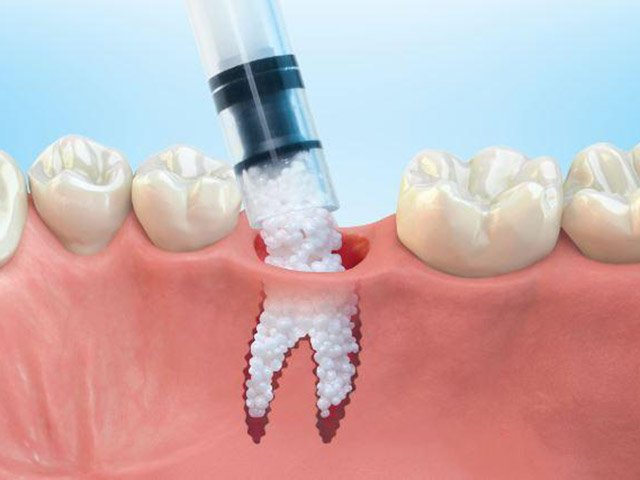 كيف يتم زراعة الاسنان و زراعة العظم