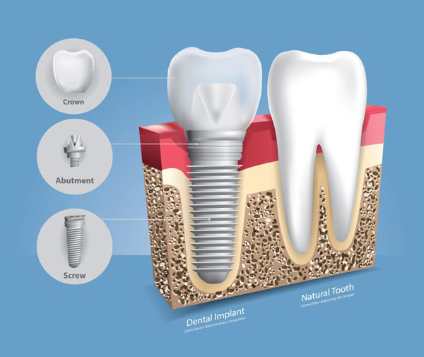 ما هي اجزاء زراعة الاسنان