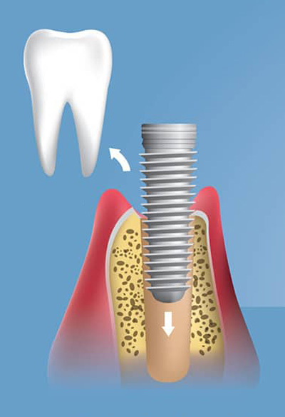 خطوة 2 زراعة الاسنان: جراحة الزراعة ووضع المثبت في العظام