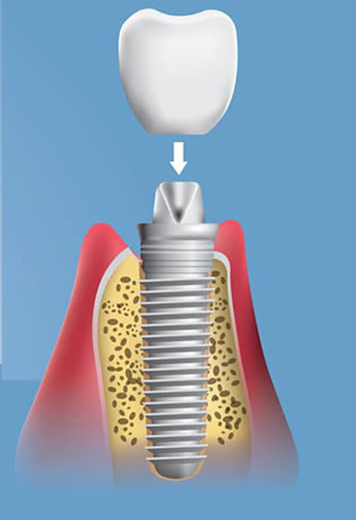 خطوة 5 زراعة الاسنان: وضع التاج 