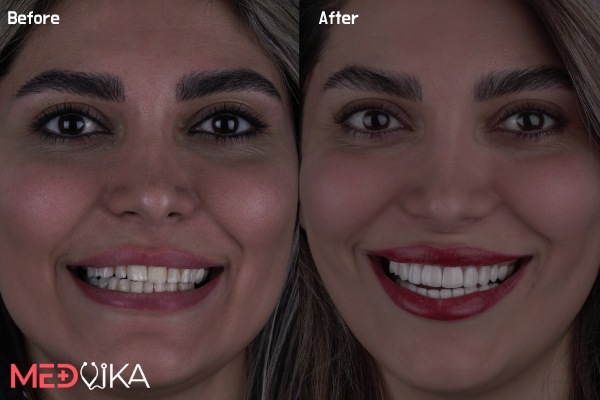 قبل و بعد لمینت دندان مشهد